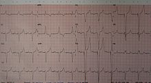 An ECG of a person with a dual-chamber pacemaker Duelchamber.JPG