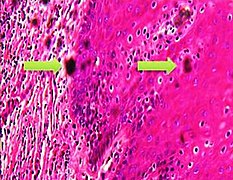 Artefactes del pigment de formalin