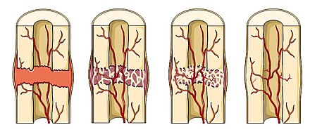 Трещина зажила. Заживление переломов костей. Прямой и непрямой остеогенез. Три стадии остеогенеза.