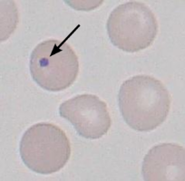 Howell-Jolly bodies indicated by arrow