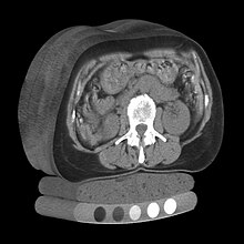 Multiple X-ray tomographs (with quantitative mineral density calibration) stacked to form a 3D model Image of 3D volumetric QCT scan.jpg