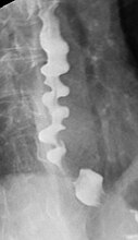 Corkscrew appearance of the esophagus.