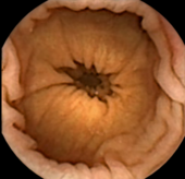 Image of the colon acquired by capsule endoscopy Normales Colon.PNG