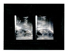 Polaroid photograph of an obstetric ultrasound taken in 1985 Obstetric Ultrasound Polaroid Photograph 1985.jpg