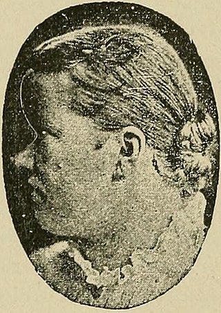 <span class="mw-page-title-main">Muenke syndrome</span> Medical condition