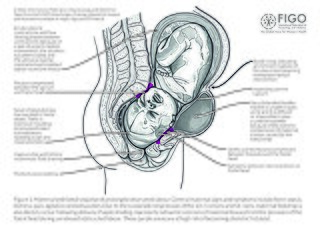 <span class="mw-page-title-main">Obstetric fistula</span> Hole that develops in the birth canal as a result of childbirth