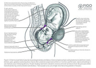 Obstetric fistula