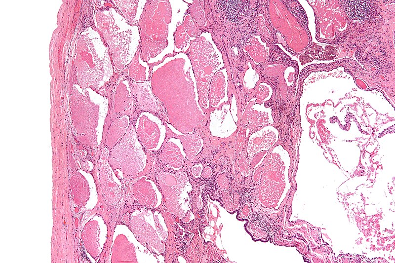 File:Pulmonary alveolar proteinosis -3- low mag.jpg