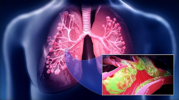 3D still showing increased mucus.