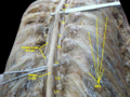 Rückenmark.  Membranen und Spinalnervenwurzeln.  tiefe Dissektion.  Rückansicht.