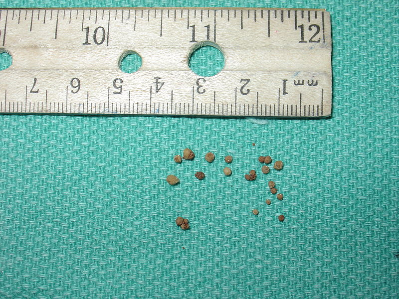 File:Small calcium oxalate stones.JPG