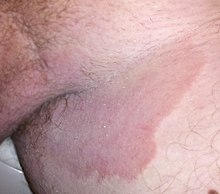 Tinea corporis Information