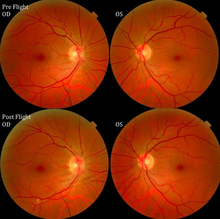 Figure 1:Fundus examination of the first case of visual changes from long-duration spaceflight. Fundus examination revealed choroidal folds inferior to the optic disc and a single cotton-wool spot in the inferior arcade of the right eye (white arrow). VIIP Figure 1.png