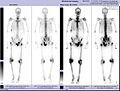 Verlauf Prostatakrebs 2010-11 Posttherapie-Szintigramm.jpg