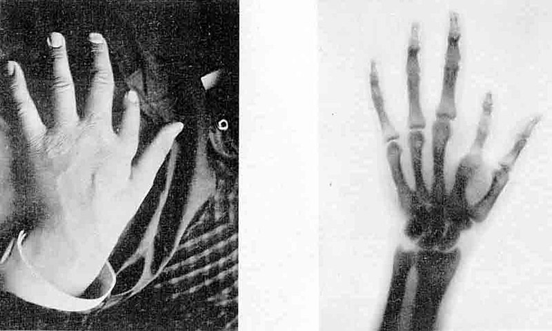File:X-ray 1896 nouvelle iconographie de salpetriere.jpg