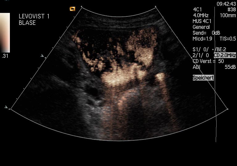 Datei:Urosonografie1.jpg