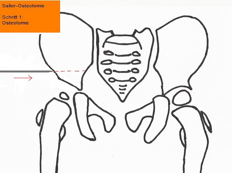 Datei:Salter-Osteotomie-Schritt1.jpg