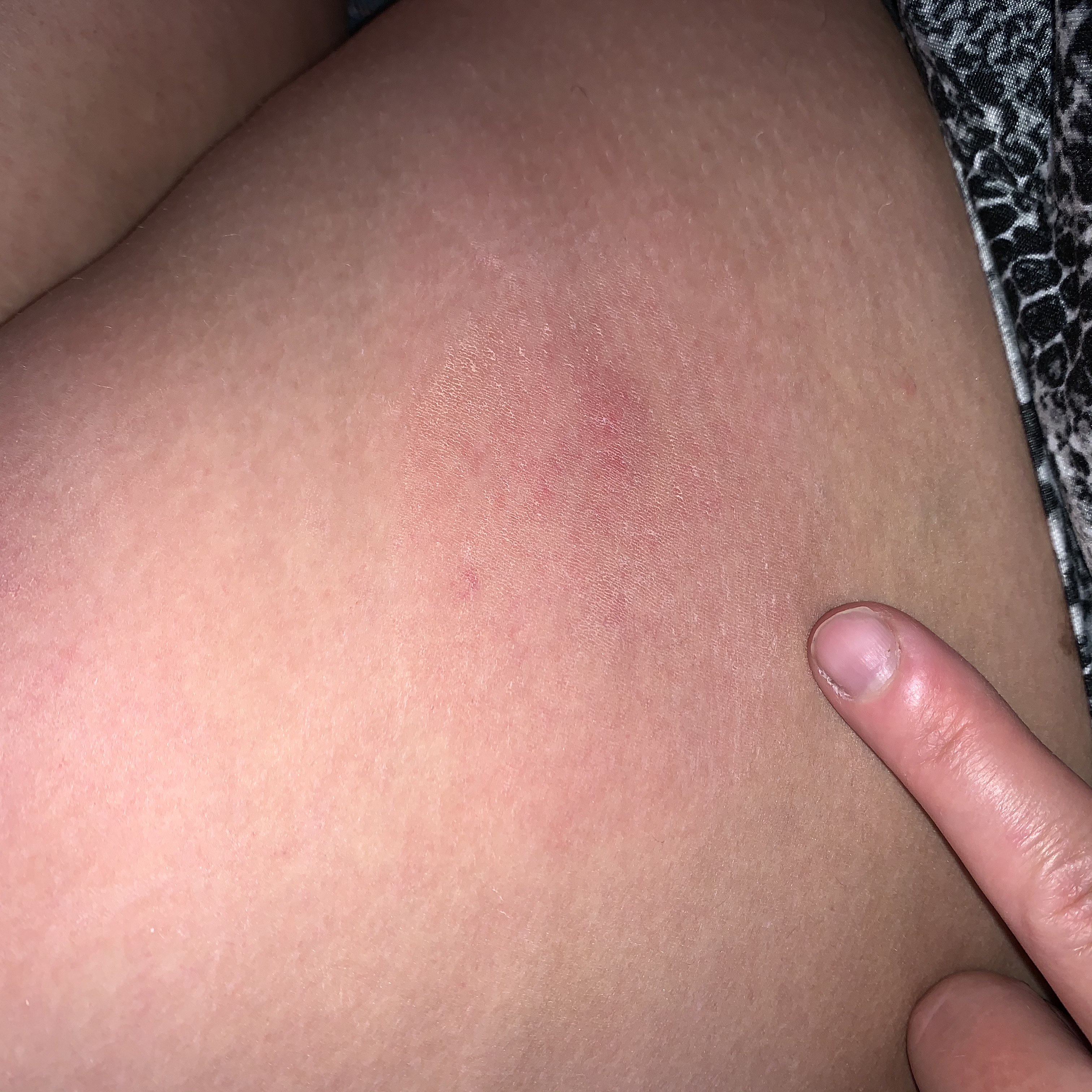 mosquito bites swelling