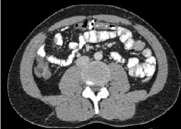 File:CT Scan Bowel.JPG