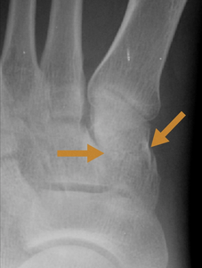 <span class="mw-page-title-main">Cuneiform fracture</span> Type of fracture of the foot