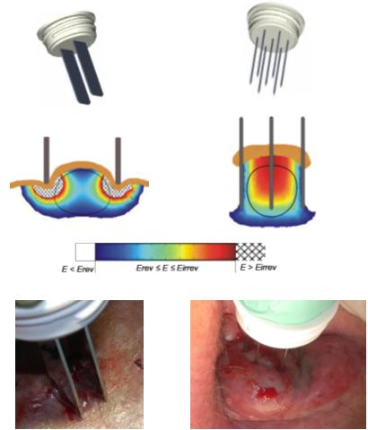 File:Electrodes ect.jpg