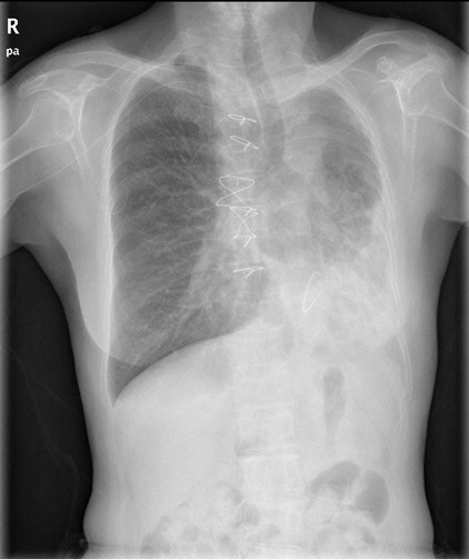 File:Chest X-ray showing left pulmonary agenesis with mediastinal shift and right lung hyperinflation.png
