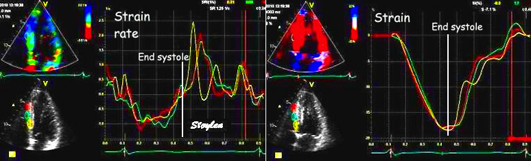 Strain rate imaging - Wikipedia