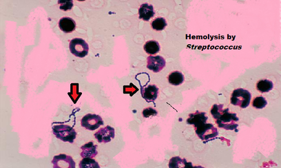 File:The process of hemolysis.png