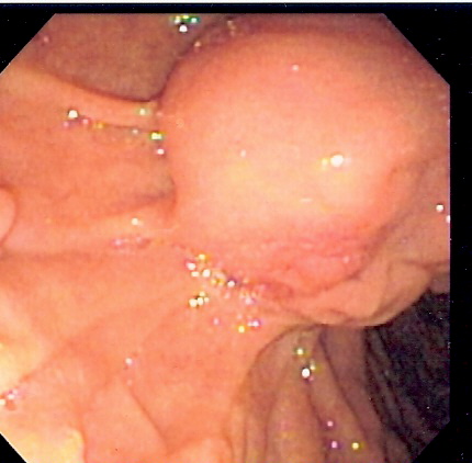 File:Impacted ampulla.jpg