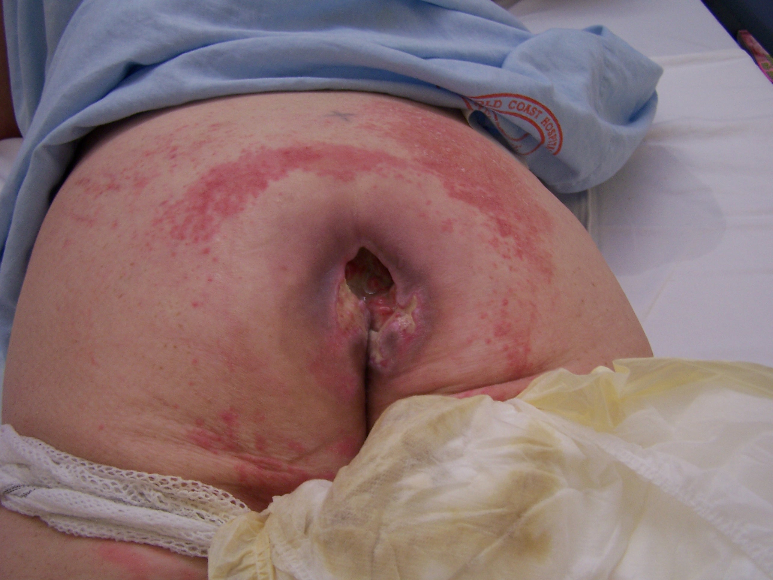 Pressure Ulcer Staging Pictures Pictures, Images & Photos ...