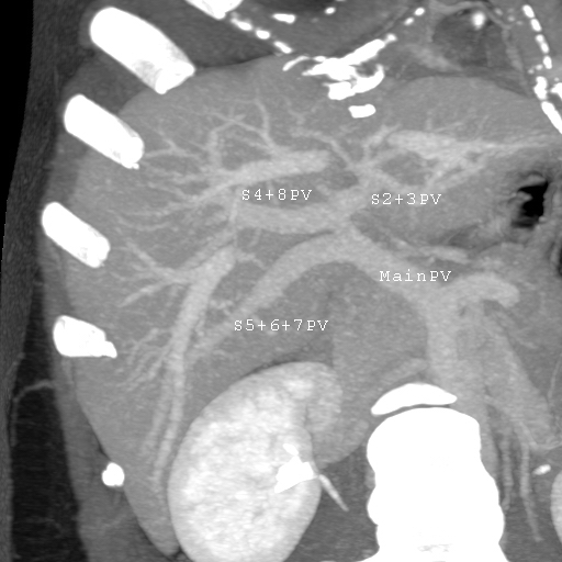 MDCT image. Portal venous anatomy contraindicated for liver donation