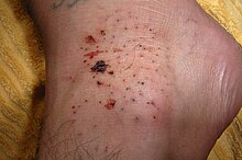 Sea urchin injury on the top side of the foot. This injury resulted in some skin staining from the natural purple-black dye of the urchin. Sea-urchin-injury.jpg