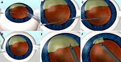 Fig 2 : GLUED IOL SCAFFOLD A- Cataract piece lying inside the eye (creamy white color). The Intraocular lens (IOL) is injected inside the eye. B- Handshake technique done to externalize the haptics of the IOL. C- Handshake technique completed. D- Both haptics of the IOL are externalized. The IOL is under the cataract piece and acts as a scaffold preventing the cataract pieces from falling down. E- The phaco handpiece emulsifies the cataract pieces using ultrasound. The glued IOl is acting as a scaffold so the technique is called glued IOL scaffold F- Cataract pieces removed. GLUED IOL SCAFFOLD.jpg