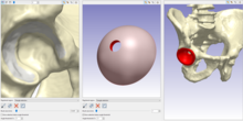 Screenshot of component being placed in hip model in Simpleware ScanIP Simpleware Component Placement.png