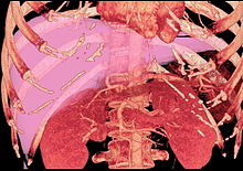 Volume rendering image created with computed tomography, which can be used to evaluate the volume of the liver of a potential donor LDLT volume measure.jpg