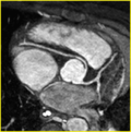 Thumbnail for Anomalous aortic origin of a coronary artery