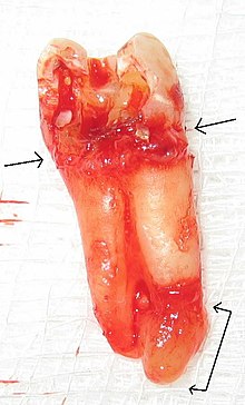 Tooth#4, the maxillary right second premolar (upper right 2nd bicuspid), after extraction. The two single-headed arrows point to the CEJ, which is the line separating the crown (in this case, heavily decayed) and the roots. The double headed arrow (bottom right) shows the extent of the abscess that surrounds the apex of the palatal root. Chronic apical periodontitis (with arrows).jpg