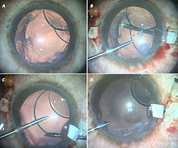 Fig 5 : A-A three piece IOL above the rhexis is still subluxated. B-Scleral flaps are made 180 degrees apart. One hand holding the ahptic with the glued IOL forceps while the other is doing vitrectomy. The capsule remnants are removed as they are not needed for the glued IOL. C-Handshake technique being done to catch the tip of the haptic. Notice the trocar cannula on the upper right. One needs fluid in the eye always. An AC maintainer also be used instead. D-One haptic externalized. Subluxated three piece IOL glued into place- Part 1.jpg