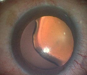 Case with a Coloboma of the lens.jpg