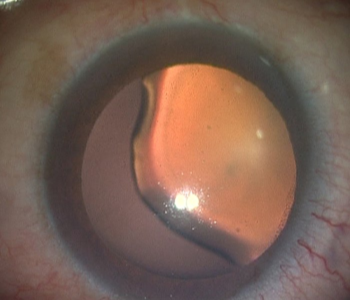 File:Case with a Coloboma of the lens.jpg
Description 	

Case with a Coloboma of the lens during surgery pic taken
Source 	

Pic taken of a case with a Coloboma of the lens while surgery
Previously published: Not Published
Date 	

2015-05-28
Author 	

Sanjoykdas
Permission
(Reusing this file) 	

See below.