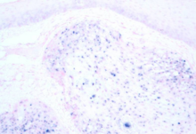 Hpv positive tumor in situ hybridization.png