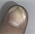 Psoriasis of a fingernail