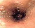 Thumbnail for Glycogenic acanthosis