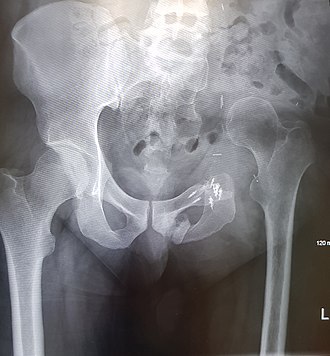 An x-ray of the same limb sparing hemipelvectomy of a male pelvis taken eighteen months after surgery highlighting the femur migration to its final resting place. Hemipelvectomy Male Pelvis.jpeg