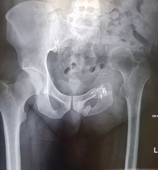 File:Hemipelvectomy Male Pelvis.jpeg