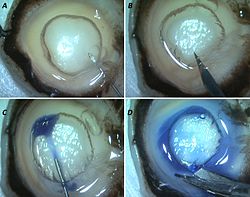 Fig 2 : Pre-Descemet's endothelial keratoplasty (PDEK). A, B: A 30 gauge needle is introduced into the centre of the cornea and air is injected. A big bubble is formed in the donor cornea on the endothelial side and it is pierced with Knife. C, D: Graft is stained or coloured by Trypan blue dye and dissected out. It describes Pdek eye surgery.jpg