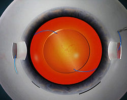 Fig 4: Glued IOL surgery. The IOL is inside the eye. Both the haptics (blue color) are externalized under the scleral flaps. They will be tucked into scleral pockets and fibrin glue applied to seal them Glued IOL surgery.jpg