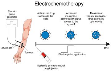 Basic steps in electrochemotherapy treatment Shema ect.jpg