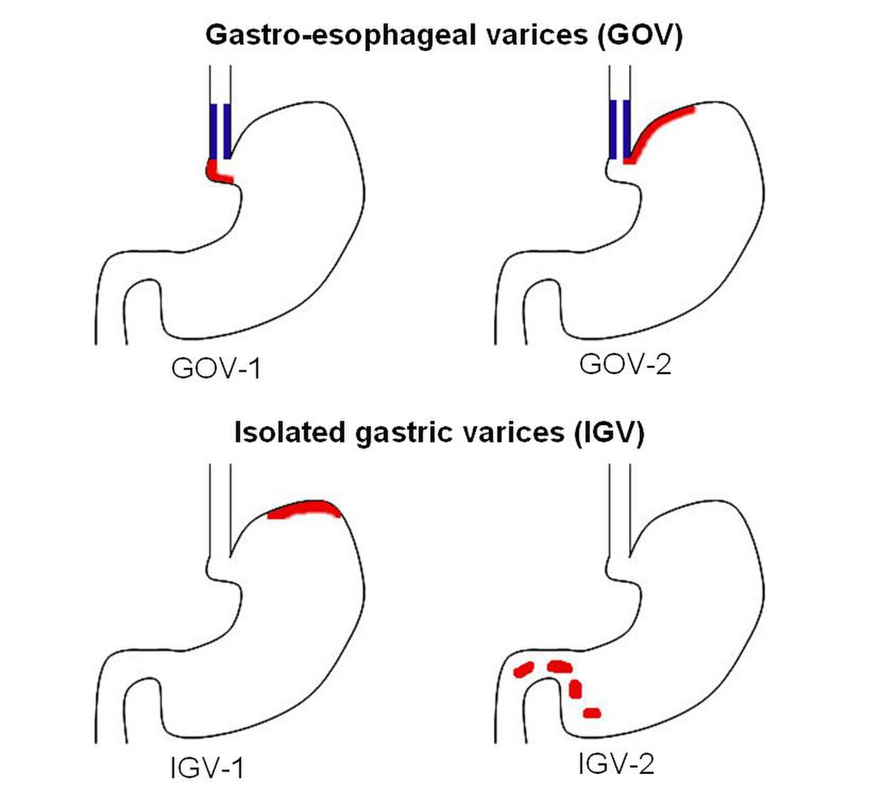 Расширение желудка. Классификация gastric varices. Вены желудка классификация. Варикозные вены желудка классификация. Классификация вен желудка по Sarin.