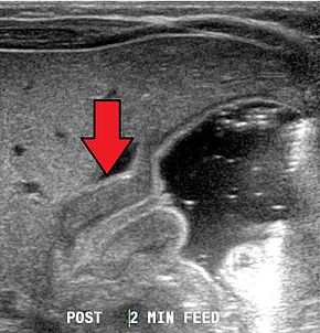 Pyloric stenosis as seen on ultrasound in a 6-week-old Pyloric-stenosisLocal.jpg